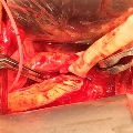External Iliac Artery Endofibrosis