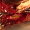 External Iliac Artery Endofibrosis