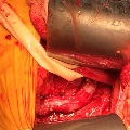 External Iliac Artery Endofibrosis